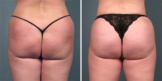 Is buttocks enhancement right for you?